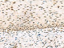 ABI2B / ABI2 Antibody - Immunohistochemistry of paraffin-embedded Human cervical cancer tissue  using ABI2 Polyclonal Antibody at dilution of 1:45(×200)