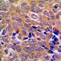 ABL Antibody - Immunohistochemical analysis of ABL1/2 staining in human breast cancer formalin fixed paraffin embedded tissue section. The section was pre-treated using heat mediated antigen retrieval with sodium citrate buffer (pH 6.0). The section was then incubated with the antibody at room temperature and detected using an HRP conjugated compact polymer system. DAB was used as the chromogen. The section was then counterstained with hematoxylin and mounted with DPX.