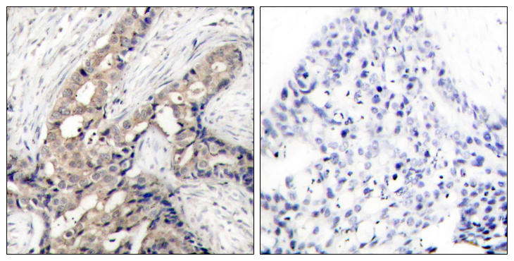 ABL Antibody - Immunohistochemistry analysis of paraffin-embedded human breast carcinoma, using Abl (Phospho-Tyr393/412) Antibody. The picture on the right is blocked with the phospho peptide.