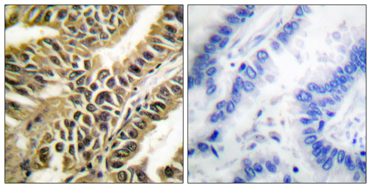 ABL1 / c-ABL Antibody - Immunohistochemistry analysis of paraffin-embedded human lung carcinoma tissue, using Abl Antibody. The picture on the right is blocked with the synthesized peptide.