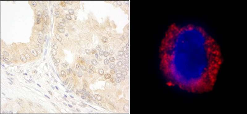 ABL1 / c-ABL Antibody - Detection of Human cAbl by Immunohistochemistry and Immunocytochemistry. Sample: FFPE section of human prostate carcinoma (left) and formaldehyde-fixed K562 cells (contains the chromosomal translocation, t(9:22) that creates the BCR/ABL fusion gene) (right). Antibody: Affinity purified rabbit anti-cAbl used at a dilution of 1:1000 (0.2 ug/ml) and 1:200 (1 ug/ml). And Red-fluorescent goat anti-rabbit IgG cross-adsorbed Antibody used at a dilution of 1:100.