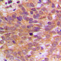 ABL1 / c-ABL Antibody - Immunohistochemical analysis of ABL1 staining in human breast cancer formalin fixed paraffin embedded tissue section. The section was pre-treated using heat mediated antigen retrieval with sodium citrate buffer (pH 6.0). The section was then incubated with the antibody at room temperature and detected using an HRP conjugated compact polymer system. DAB was used as the chromogen. The section was then counterstained with hematoxylin and mounted with DPX.