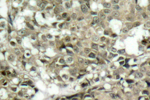 ABL1 / c-ABL Antibody - IHC of c-Abl (L406) pAb in paraffin-embedded human breast carcinoma tissue.