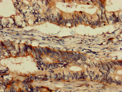 ABL1 / c-ABL Antibody - IHC image of ABL1 Antibody diluted at 1:1200 and staining in paraffin-embedded human colon cancer performed on a Leica BondTM system. After dewaxing and hydration, antigen retrieval was mediated by high pressure in a citrate buffer (pH 6.0). Section was blocked with 10% normal goat serum 30min at RT. Then primary antibody (1% BSA) was incubated at 4°C overnight. The primary is detected by a biotinylated secondary antibody and visualized using an HRP conjugated SP system.