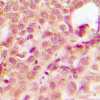 ABL1 / c-ABL Antibody - Immunohistochemical analysis of ABL1 staining in human breast cancer formalin fixed paraffin embedded tissue section. The section was pre-treated using heat mediated antigen retrieval with sodium citrate buffer (pH 6.0). The section was then incubated with the antibody at room temperature and detected using an HRP conjugated compact polymer system. DAB was used as the chromogen. The section was then counterstained with hematoxylin and mounted with DPX.