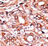 ABL1 / c-ABL Antibody - Formalin-fixed and paraffin-embedded human cancer tissue reacted with the primary antibody, which was peroxidase-conjugated to the secondary antibody, followed by AEC staining. This data demonstrates the use of this antibody for immunohistochemistry; clinical relevance has not been evaluated. BC = breast carcinoma; HC = hepatocarcinoma.