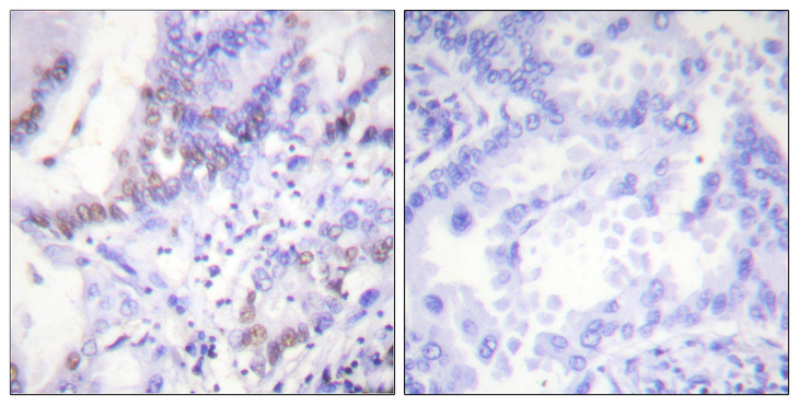 ABL1 / c-ABL Antibody - Immunohistochemistry analysis of paraffin-embedded human lung carcinoma, using Abl (Phospho-Tyr412) Antibody. The picture on the right is blocked with the phospho peptide.