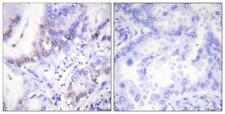 ABL1 / c-ABL Antibody - Immunohistochemistry analysis of paraffin-embedded human lung carcinoma, using Abl (Phospho-Tyr412) Antibody. The picture on the right is blocked with the phospho peptide.