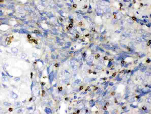 ABL2 Antibody - IHC analysis of ABL2 using anti-ABL2 antibody. ABL2 was detected in paraffin-embedded section of human lung cancer tissues. Heat mediated antigen retrieval was performed in citrate buffer (pH6, epitope retrieval solution) for 20 mins. The tissue section was blocked with 10% goat serum. The tissue section was then incubated with 1µg/ml rabbit anti-ABL2 Antibody overnight at 4°C. Biotinylated goat anti-rabbit IgG was used as secondary antibody and incubated for 30 minutes at 37°C. The tissue section was developed using Strepavidin-Biotin-Complex (SABC) with DAB as the chromogen.
