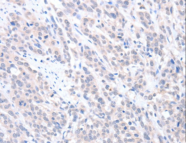ABLIM1 Antibody - Immunohistochemistry of paraffin-embedded Human esophagus cancer using ABLIM1 Polyclonal Antibody at dilution of 1:25.