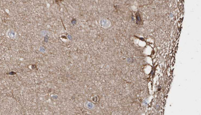 ABLIM1 Antibody - 1:100 staining human brain carcinoma tissue by IHC-P. The sample was formaldehyde fixed and a heat mediated antigen retrieval step in citrate buffer was performed. The sample was then blocked and incubated with the antibody for 1.5 hours at 22°C. An HRP conjugated goat anti-rabbit antibody was used as the secondary.