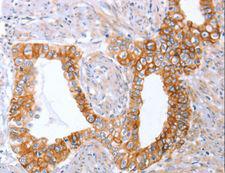 ABO Glycosyltransferase Antibody - Immunohistochemistry of paraffin-embedded Human liver cancer using ABO Polyclonal Antibody at dilution of 1:50.