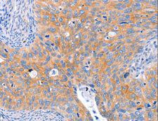 ABO Glycosyltransferase Antibody - Immunohistochemistry of paraffin-embedded Human lung cancer using ABO Polyclonal Antibody at dilution of 1:50.