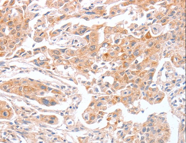 ABO Glycosyltransferase Antibody - Immunohistochemistry of paraffin-embedded Human lung cancer using ABO Polyclonal Antibody at dilution of 1:50.