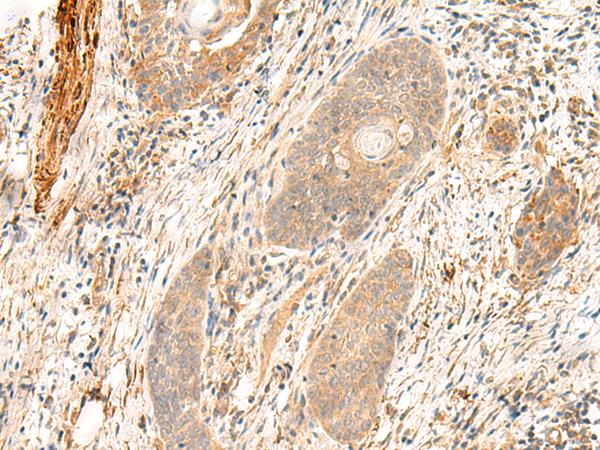 ABP-280 / FLNC Antibody - Immunohistochemistry of paraffin-embedded Human esophagus cancer tissue  using FLNC Polyclonal Antibody at dilution of 1:35(×200)