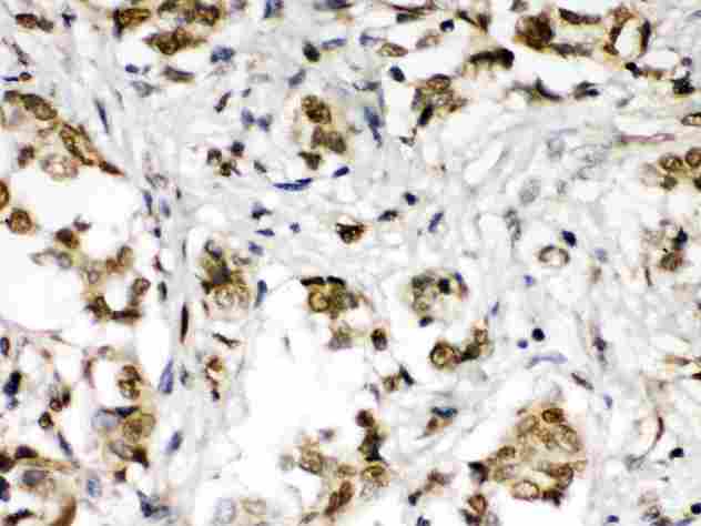 ABR Antibody - ABR was detected in paraffin-embedded sections of human mammary cancer tissues using rabbit anti- ABR Antigen Affinity purified polyclonal antibody