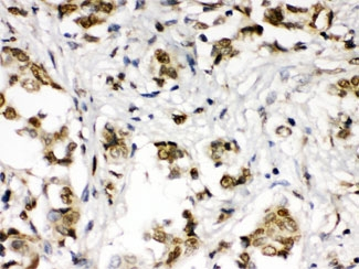 ABR Antibody - IHC testing of FFPE human breast cancer tissue with ABR antibody at 1ug/ml. HIER: steam in pH6 citrate buffer and allow to cool prior to staining.