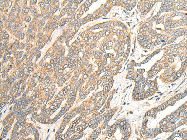 ABRI / ITM2B Antibody - Immunohistochemistry of paraffin-embedded Human liver cancer tissue  using ITM2B Polyclonal Antibody at dilution of 1:35(×200)