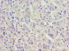 ACAA1 Antibody - Immunohistochemistry of paraffin-embedded human liver cancer using antibody at 1:100 dilution.
