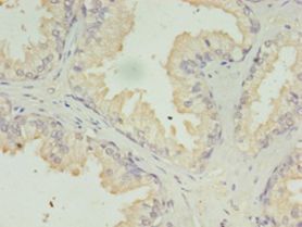 ACAA1 Antibody - Immunohistochemistry of paraffin-embedded human prostate cancer gland using antibody at 1:100 dilution.  This image was taken for the unconjugated form of this product. Other forms have not been tested.