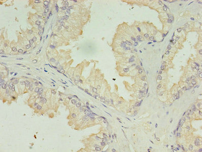 ACAA1 Antibody - Immunohistochemistry of paraffin-embedded human prostate cancer using ACAA1 Antibody at dilution of 1:100