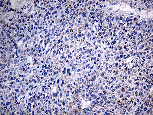 ACAA1 Antibody - Immunohistochemical staining of paraffin-embedded Carcinoma of Human liver tissue using anti-ACAA1 mouse monoclonal antibody. (Heat-induced epitope retrieval by 1mM EDTA in 10mM Tris buffer. (pH8.5) at 120°C for 3 min. (1:500)