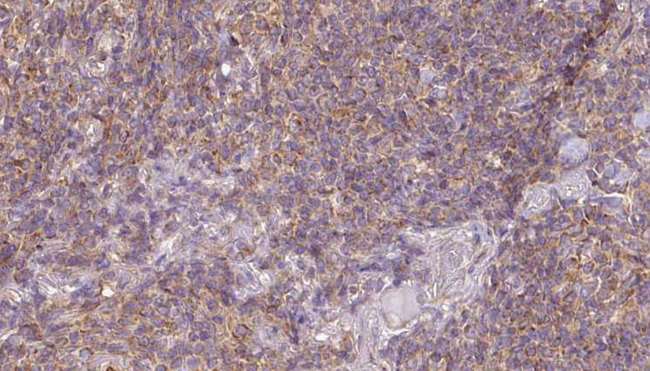 ACAA1 Antibody - 1:100 staining human lymph carcinoma tissue by IHC-P. The sample was formaldehyde fixed and a heat mediated antigen retrieval step in citrate buffer was performed. The sample was then blocked and incubated with the antibody for 1.5 hours at 22°C. An HRP conjugated goat anti-rabbit antibody was used as the secondary.