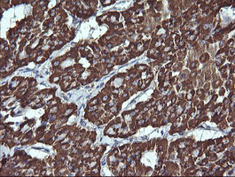 ACAA2 Antibody - IHC of paraffin-embedded Carcinoma of Human thyroid tissue using anti-ACAA2 mouse monoclonal antibody.