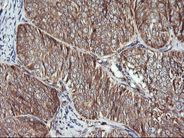 ACAA2 Antibody - IHC of paraffin-embedded Adenocarcinoma of Human ovary tissue using anti-ACAA2 mouse monoclonal antibody.