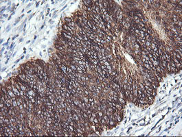 ACAA2 Antibody - IHC of paraffin-embedded Carcinoma of Human pancreas tissue using anti-ACAA2 mouse monoclonal antibody.