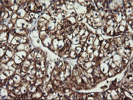 ACAA2 Antibody - IHC of paraffin-embedded Carcinoma of Human kidney tissue using anti-ACAA2 mouse monoclonal antibody. (Heat-induced epitope retrieval by 10mM citric buffer, pH6.0, 120°C for 3min).