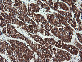 ACAA2 Antibody - IHC of paraffin-embedded Carcinoma of Human liver tissue using anti-ACAA2 mouse monoclonal antibody.
