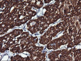 ACAA2 Antibody - IHC of paraffin-embedded Carcinoma of Human thyroid tissue using anti-ACAA2 mouse monoclonal antibody.