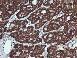 ACAA2 Antibody - IHC of paraffin-embedded Carcinoma of Human thyroid tissue using anti-ACAA2 mouse monoclonal antibody. (Heat-induced epitope retrieval by 10mM citric buffer, pH6.0, 120°C for 3min).