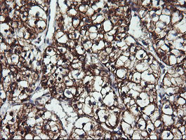 ACAA2 Antibody - IHC of paraffin-embedded Carcinoma of Human kidney tissue using anti-ACAA2 mouse monoclonal antibody.