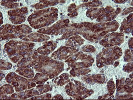ACAA2 Antibody - IHC of paraffin-embedded Carcinoma of Human liver tissue using anti-ACAA2 mouse monoclonal antibody. (Heat-induced epitope retrieval by 10mM citric buffer, pH6.0, 120°C for 3min).