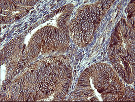 ACAA2 Antibody - IHC of paraffin-embedded Adenocarcinoma of Human endometrium tissue using anti-ACAA2 mouse monoclonal antibody. (Heat-induced epitope retrieval by 10mM citric buffer, pH6.0, 120°C for 3min).