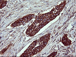 ACAA2 Antibody - IHC of paraffin-embedded Carcinoma of Human bladder tissue using anti-ACAA2 mouse monoclonal antibody. (Heat-induced epitope retrieval by 10mM citric buffer, pH6.0, 120°C for 3min).
