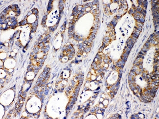 ACAA2 Antibody - IHC testing of FFPE human intestinal cancer tissue with ACAA2 antibody at 1ug/ml. HIER: steam sections in pH6 citrate buffer for 20 min.