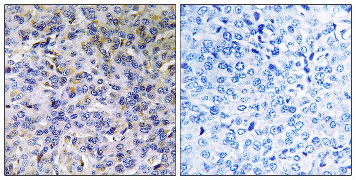 ACAD11 Antibody - Peptide - + Immunohistochemistry analysis of paraffin-embedded human breast carcinoma tissue using ACD11 antibody.
