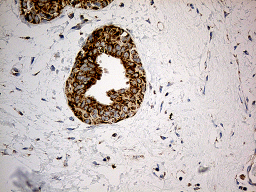 ACAD9 Antibody - Immunohistochemical staining of paraffin-embedded Human breast tissue within the normal limits using anti-ACAD9 mouse monoclonal antibody. (Heat-induced epitope retrieval by 1mM EDTA in 10mM Tris buffer. (pH8.5) at 120°C for 3 min. (1:500)