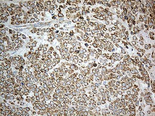ACAD9 Antibody - Immunohistochemical staining of paraffin-embedded Adenocarcinoma of Human breast tissue tissue using anti-ACAD9 mouse monoclonal antibody. (Heat-induced epitope retrieval by 1mM EDTA in 10mM Tris buffer. (pH8.5) at 120°C for 3 min. (1:500)