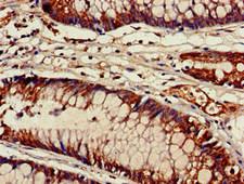 ACAD9 Antibody - Immunohistochemistry of paraffin-embedded human colon cancer at dilution of 1:100