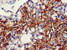 ACADSB Antibody - Immunohistochemistry of paraffin-embedded human lung cancer at dilution of 1:100