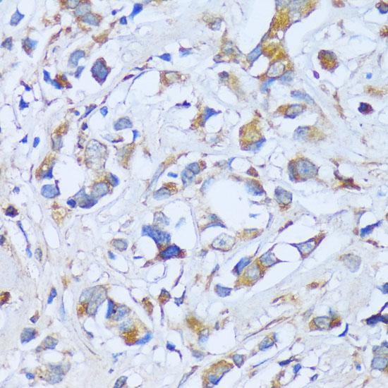 ACADSB Antibody - Immunohistochemistry of paraffin-embedded Human breast cancer using ACADSB Polyclonal Antibody at dilution of 1:100 (40x lens).