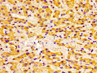 ACADVL Antibody - Immunohistochemistry image of paraffin-embedded human liver cancer at a dilution of 1:100