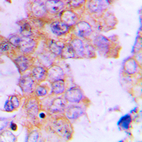 ACAT1 Antibody - Immunohistochemical analysis of ACAT1 staining in human lung cancer formalin fixed paraffin embedded tissue section. The section was pre-treated using heat mediated antigen retrieval with sodium citrate buffer (pH 6.0). The section was then incubated with the antibody at room temperature and detected using an HRP conjugated compact polymer system. DAB was used as the chromogen. The section was then counterstained with hematoxylin and mounted with DPX.
