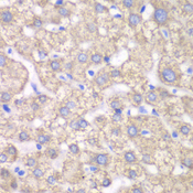 ACAT1 Antibody - Immunohistochemistry of paraffin-embedded human liver injury tissue.