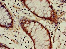 ACAT1 Antibody - Immunohistochemistry of paraffin-embedded human colon cancer at dilution of 1:100