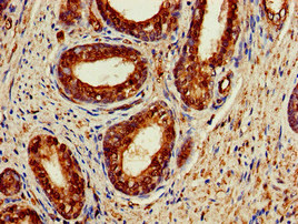 ACAT1 Antibody - Immunohistochemistry of paraffin-embedded human prostate cancer at dilution of 1:100